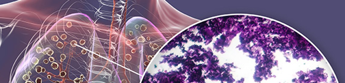 Schemazeichnung einer Lunge mit einem fibrotischen Ausschnitt des Lungengewebes