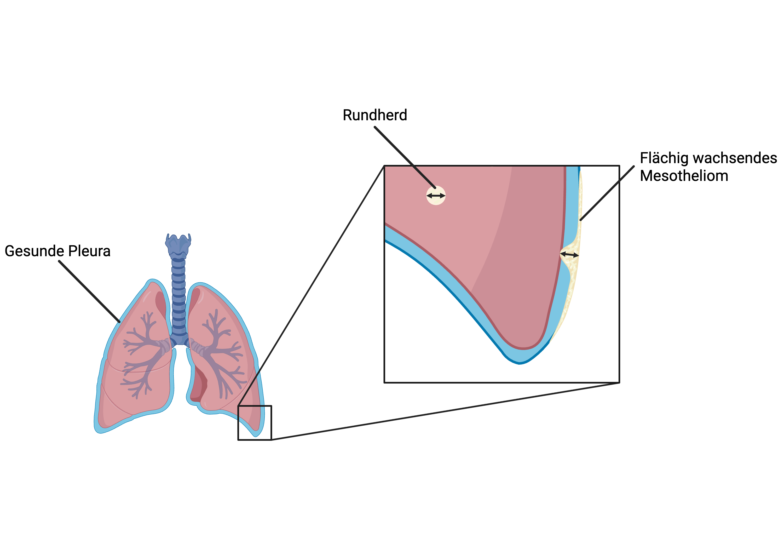 Bei gleicher radiologischer Dicke (gleiche Pfeillänge) haben die flächig wachsenden Mesotheliome bei Entdeckung deutlich mehr Volumen als Rundherde.